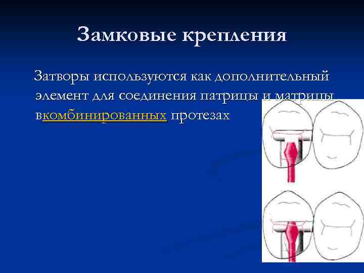 Замковые крепления Затворы используются как дополнительный элемент для соединения патрицы и матрицы вкомбинированных протезах