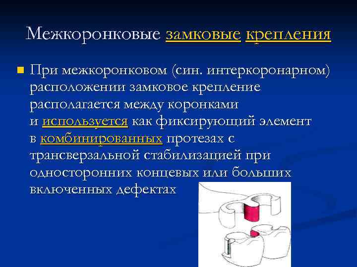 Межкоронковые замковые крепления n При межкоронковом (син. интеркоронарном) расположении замковое крепление располагается между коронками
