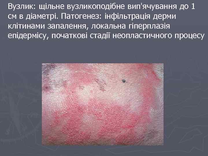 Вузлик: щільне вузликоподібне вип'ячування до 1 см в діаметрі. Патогенез: інфільтрація дерми клітинами запалення,