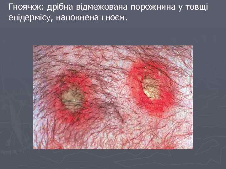Гноячок: дрібна відмежована порожнина у товщі епідермісу, наповнена гноєм. 