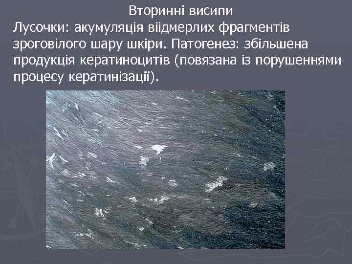 Вторинні висипи Лусочки: акумуляція віідмерлих фрагментів зроговілого шару шкіри. Патогенез: збільшена продукція кератиноцитів (повязана