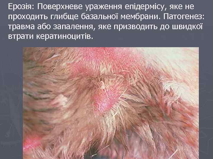 Ерозія: Поверхневе ураження епідермісу, яке не проходить глибще базальної мембрани. Патогенез: травма або запалення,