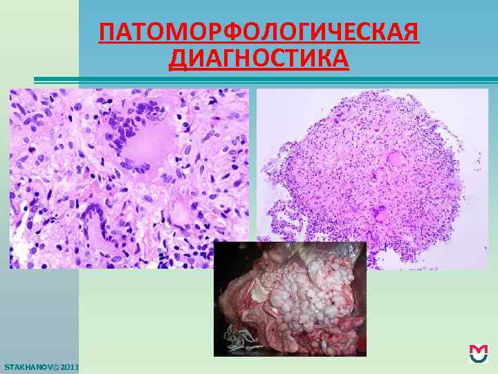 ПАТОМОРФОЛОГИЧЕСКАЯ ДИАГНОСТИКА STAKHANOV© 2011 