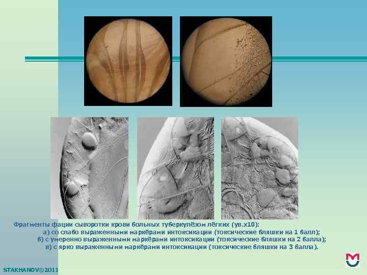 Фрагменты фации сыворотки крови больных туберкулёзом лёгких (ув. х10): а) со слабо выраженными маркёрами