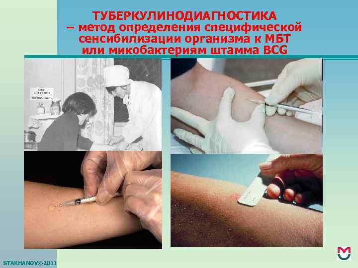 ТУБЕРКУЛИНОДИАГНОСТИКА – метод определения специфической сенсибилизации организма к МБТ или микобактериям штамма BCG STAKHANOV©