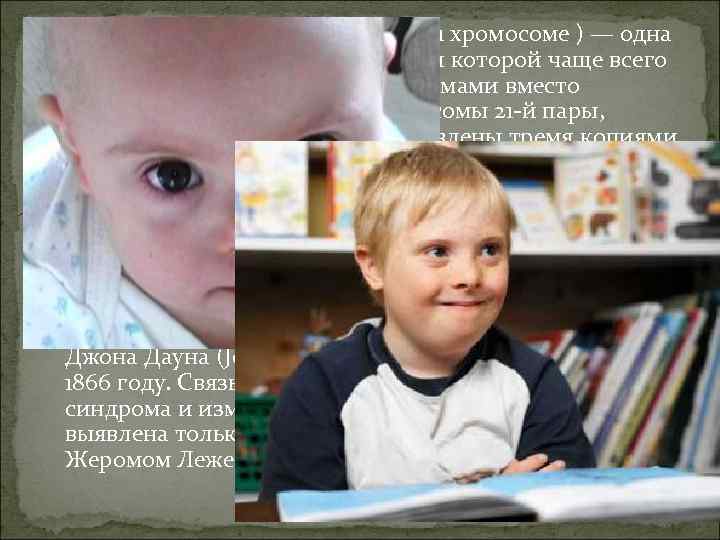  Синдром Да уна (трисомия X по 21 хромосоме ) — одна из форм