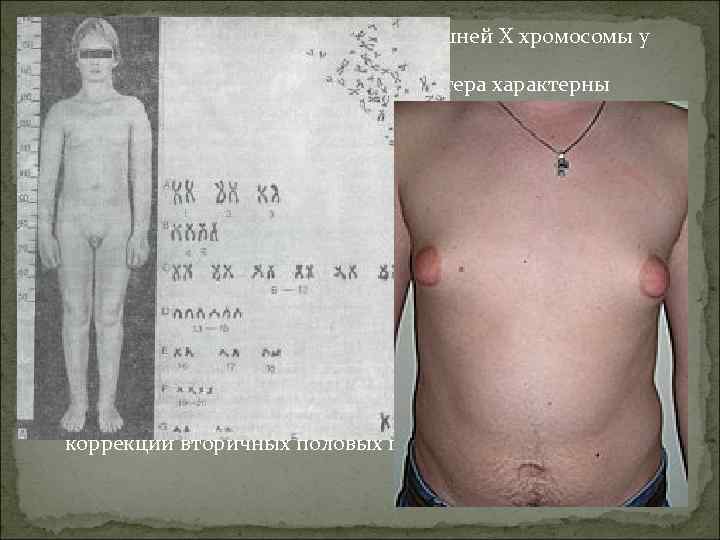  Болезнь Кляйнфельтера- наличие лишней X хромосомы у мужчин (генотип – XXY). Для мужчин