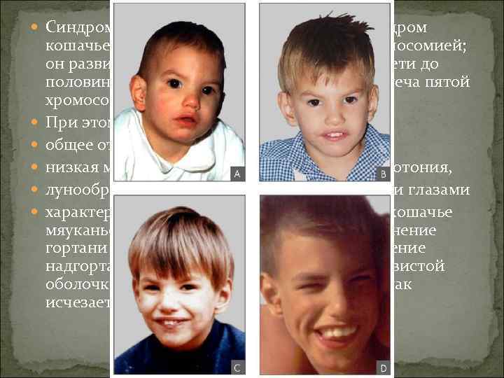  Синдром Кошачьего крика-Хромосомно синдром кошачьего крика объясняется частичной моносомией; он развивается при делеции