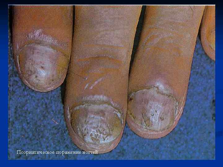 Псориатическое поражение ногтей 