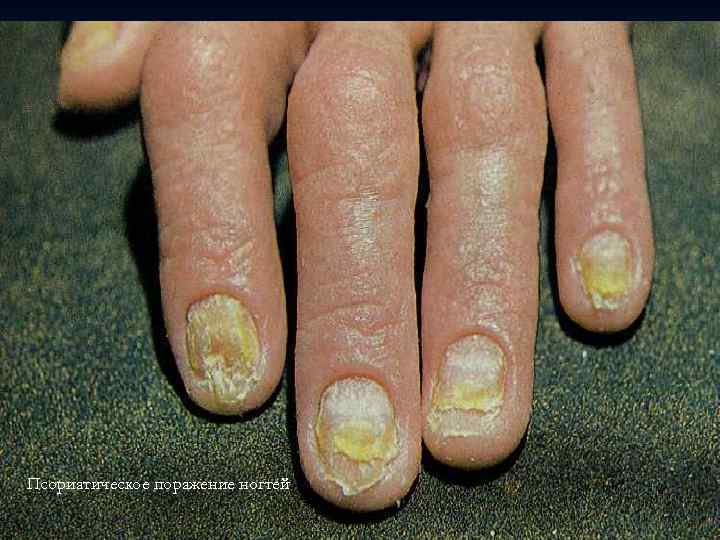Псориатическое поражение ногтей 