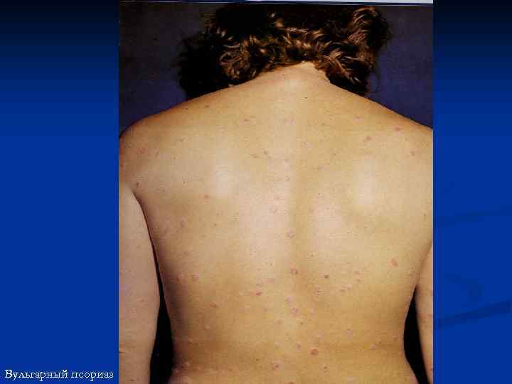 Вульгарный псориаз 
