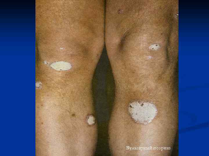 Вульгарный псориаз 
