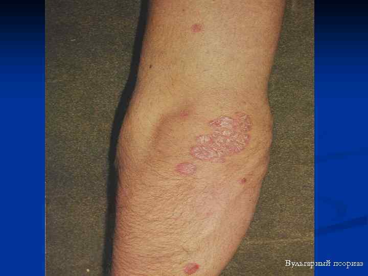 Вульгарный псориаз 