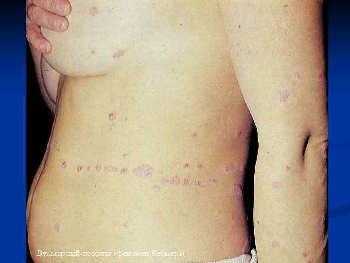 Вульгарный псориаз (феномен Кебнера) 