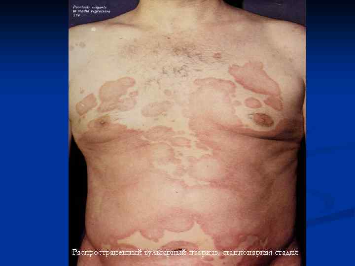 Распространенный вульгарный псориаз, стационарная стадия 