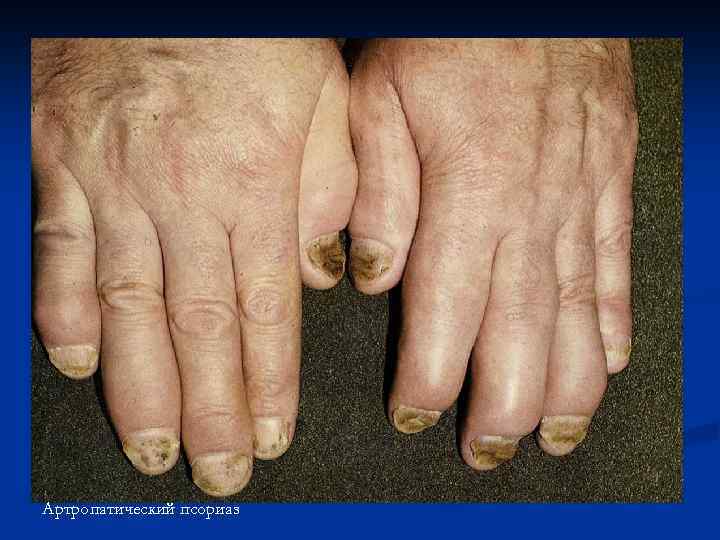 Артропатический псориаз 