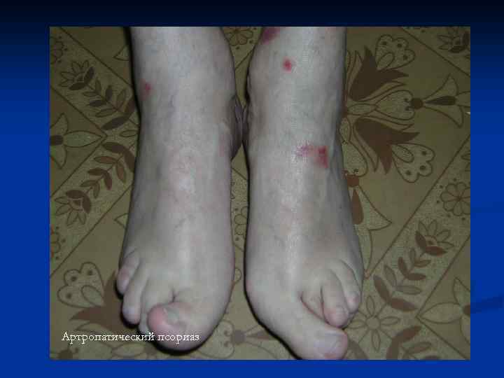 Артропатический псориаз 
