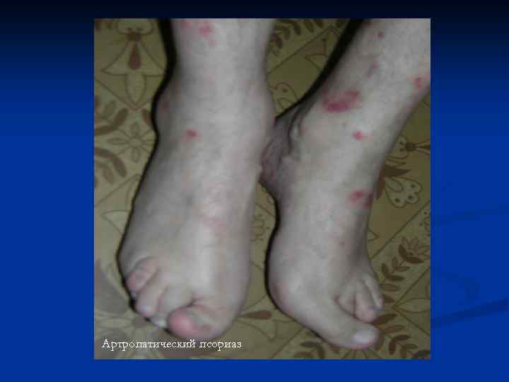 Артропатический псориаз 