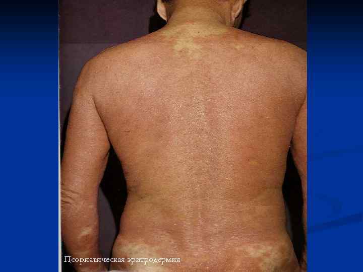 Псориатическая эритродермия 