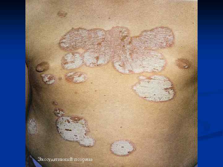 Экссудативный псориаз 