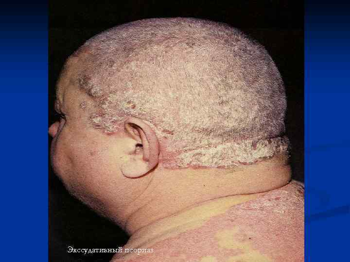 Экссудативный псориаз 