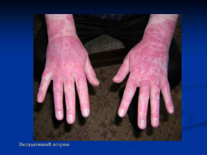 Экссудативный псориаз 