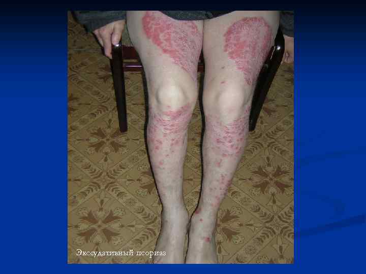 Экссудативный псориаз 