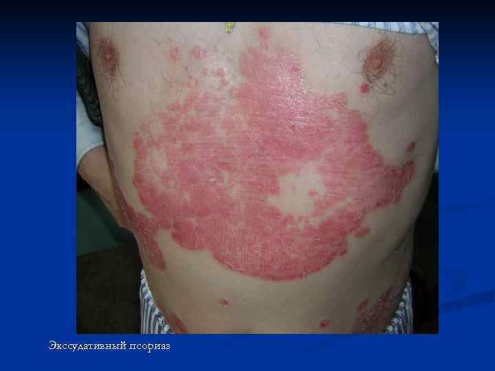 Экссудативный псориаз 