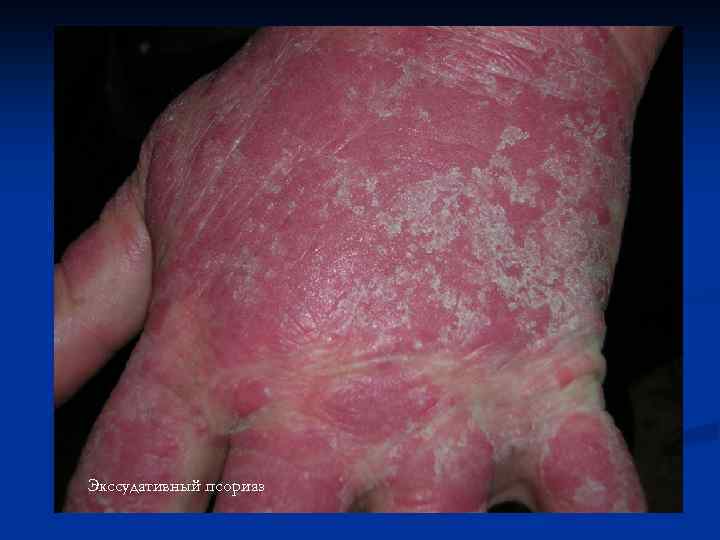 Экссудативный псориаз 
