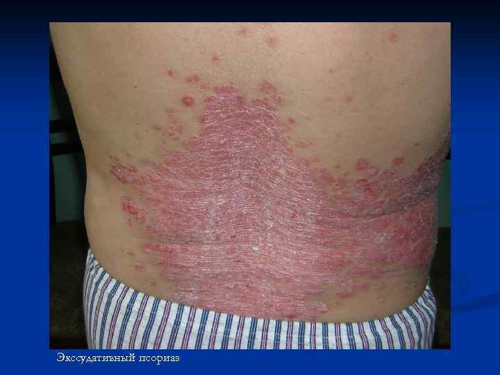 Экссудативный псориаз 