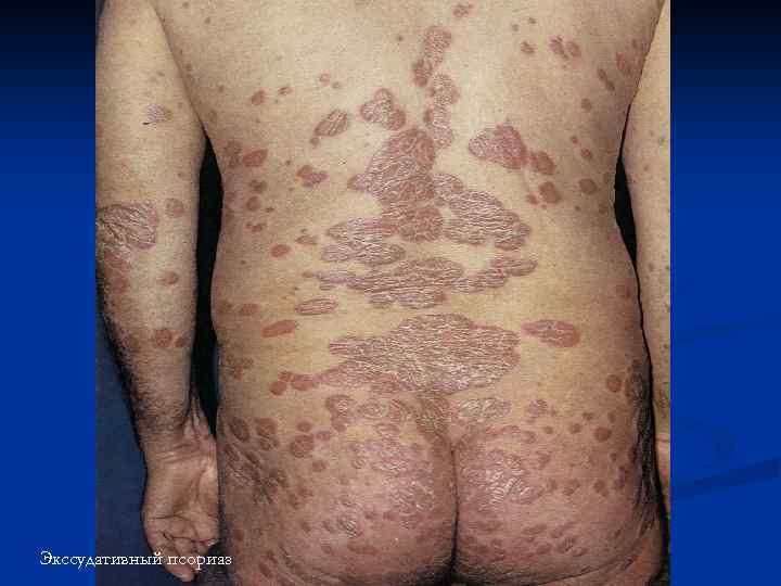 Экссудативный псориаз 