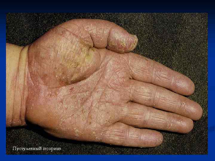 Пустулезный псориаз 