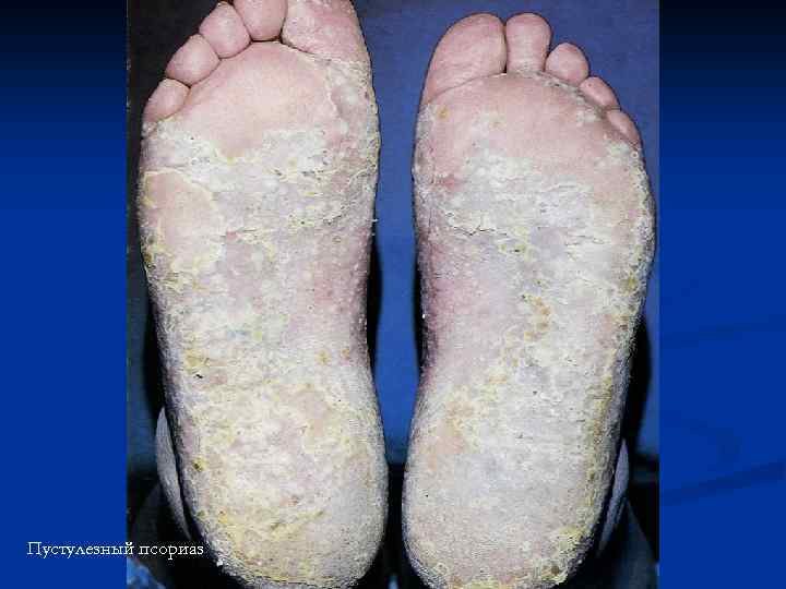 Пустулезный псориаз 