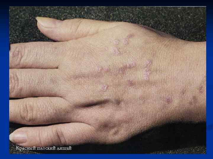 Красный плоский лишай 