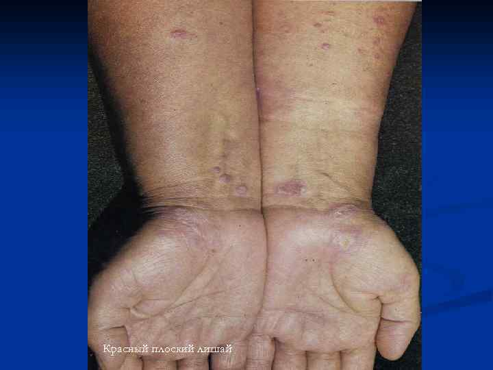 Красный плоский лишай 