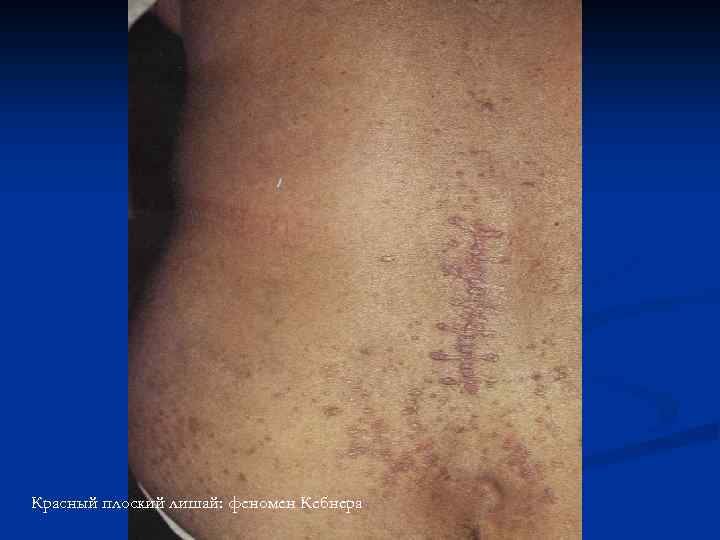 Красный плоский лишай: феномен Кебнера 