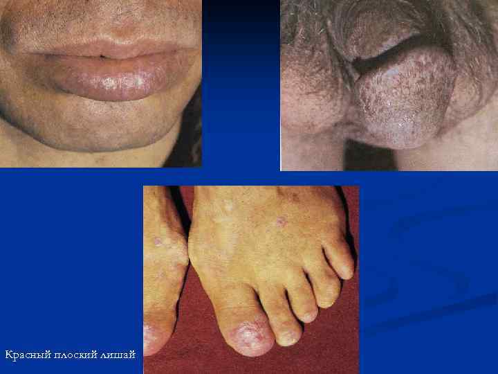 Красный плоский лишай 