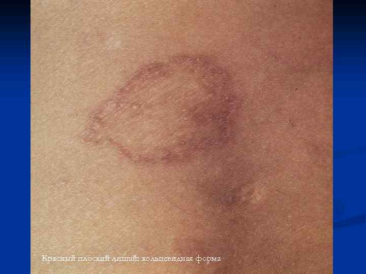 Красный плоский лишай: кольцевидная форма 