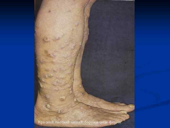 Красный плоский лишай: бородавчатая форма 