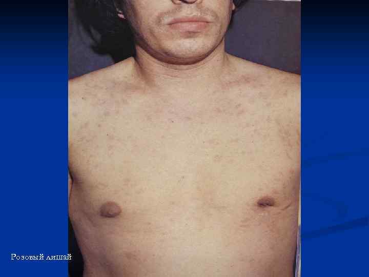 Розовый лишай 