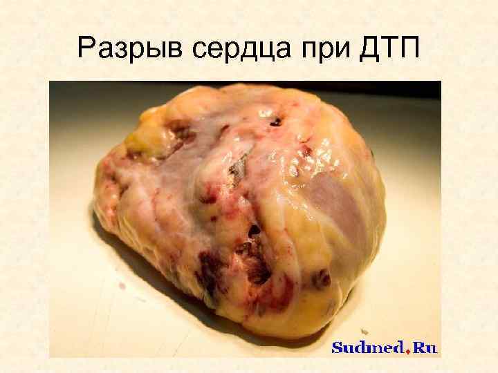 Разрыв сердца при ДТП 