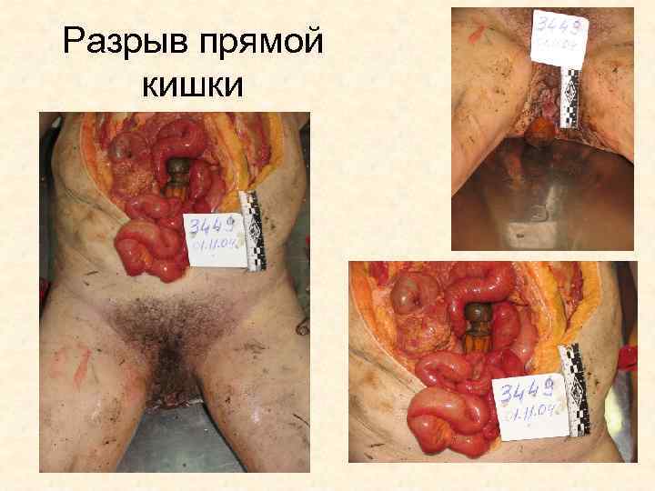 Разрыв прямой кишки 