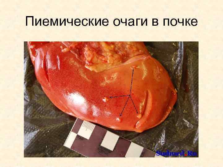 Пиемические очаги в почке 