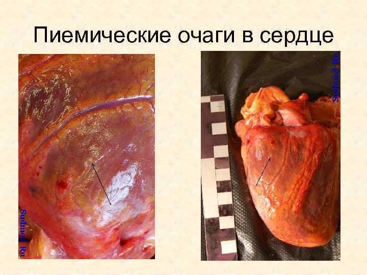 Пиемические очаги в сердце 