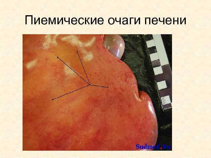 Пиемические очаги печени 