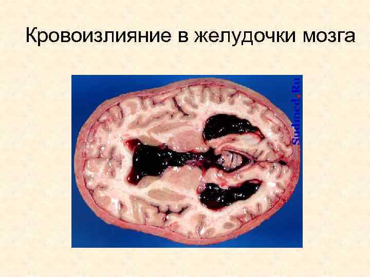 Кровоизлияние в желудочки мозга 