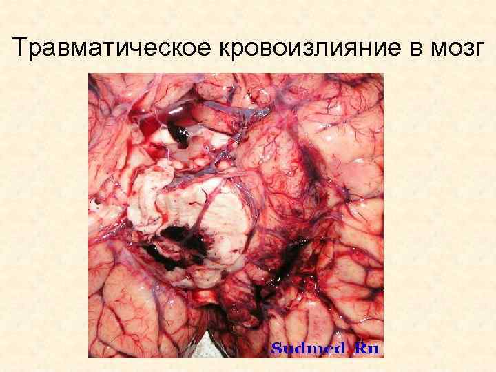 Травматическое кровоизлияние в мозг 