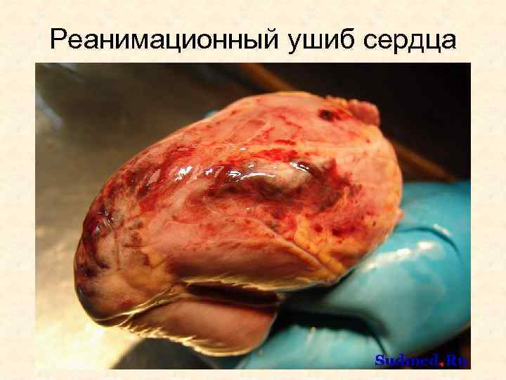 Реанимационный ушиб сердца 