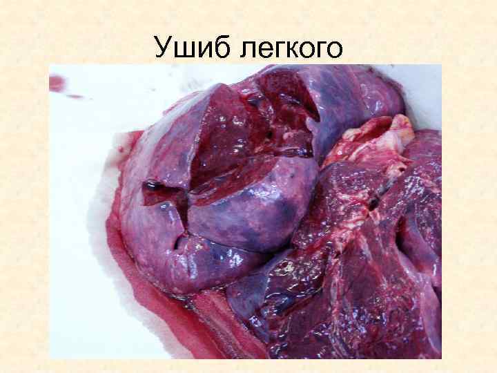 Ушиб легкого 