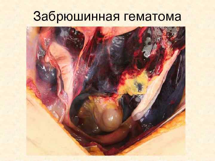 Забрюшинная гематома 